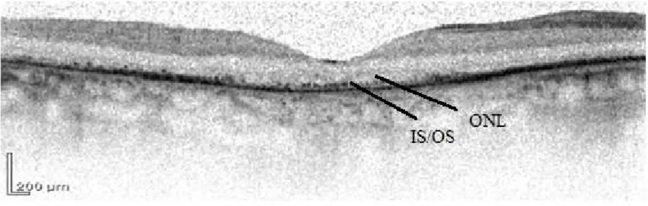 5. ábra Retinitis pigmentosás beteg retinájának a macula területében OCT készülékkel  készített  felvétele