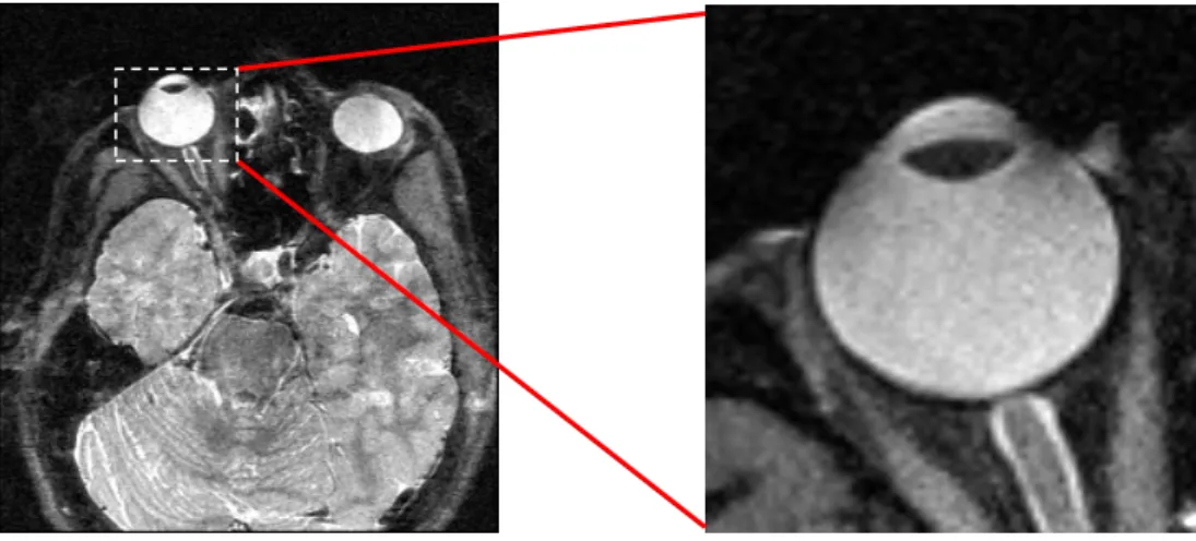 9. ábra A szemgolyóról készített általunk kidolgozott MRI szekvencia által létrehozott  kép és a kinagyított bulbus (TR 10 s, TE 21 ms és térbeli felbontás 0,7x0,7x0.7 mm 3 )