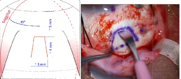 10. ábra Sclera lebeny készítése a felső (A Retina Implant AG engedélyével)