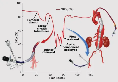 Figure  3.  This  graph  illustrates  the  decline  in  lower  extremity  transcutaneous oxygen saturation (StO 2 ) with placement of large diameter  sheaths  in  the  iliofemoral  arteries