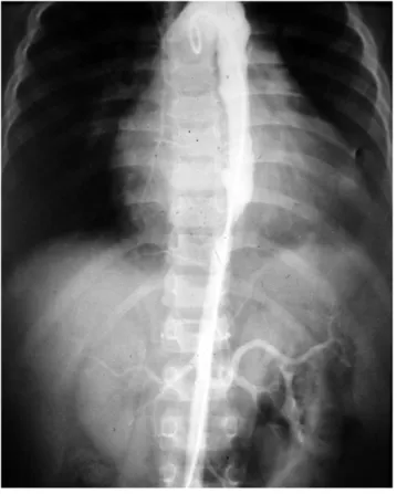 5. ábra 14 éves lány hypertoniáját intervisceralis, suprarenalis aorta- aorta-coarctatio okozta