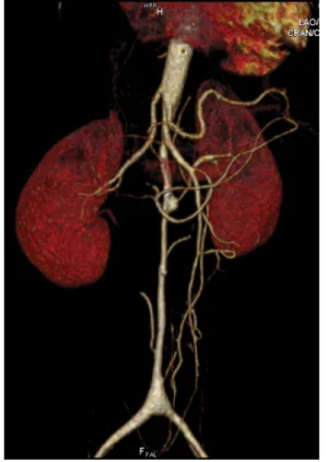 6. ábra 24 éves nő mérsékelt hypertoniával aorta abdominalis coarctatió- coarctatió-val került műtétre