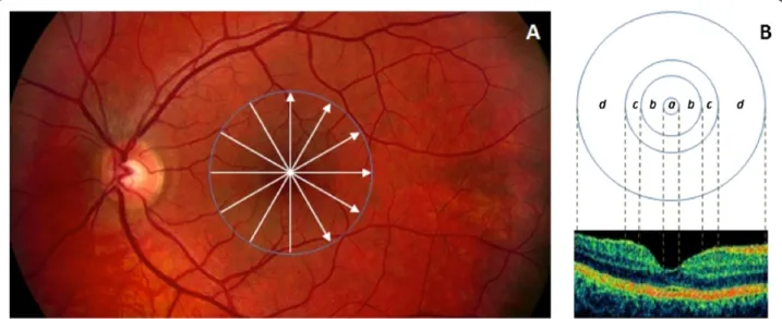Figure 1 Custom-built method showing macular sectors. A) Fundus image of a healthy eye showing the Stratus OCT ’ s radial lines protocol.