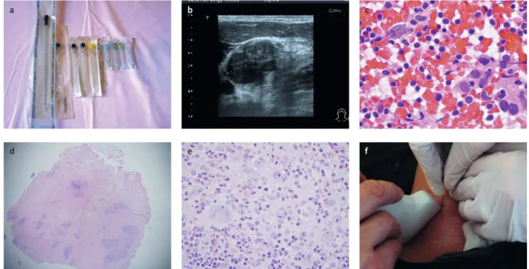 8. ábra. a) Aspirációs tűtípusok. b) Hodgkin-kór nyirokcsomó-UH-képe. c) A száraz, kissé véres keneten kevés a diagnosztikus sejt