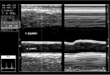 13. ábra: Az a. carotis osztott képernyős ultrahang felvétele. Az ábra bal oldalán az ér  B-módban  látható,  a  bőr-kötőszövet-vena  jugularis  képletek  alatt