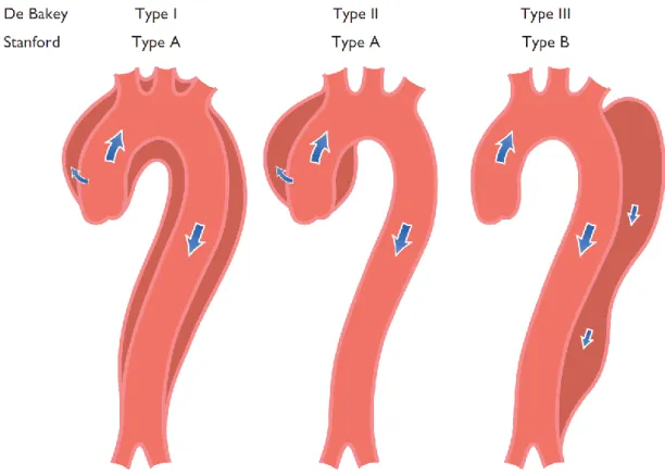 5. ábra Az aorta disszekciók DeBakey és Stanford klasszifikációja 16