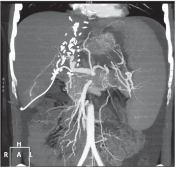 4. ábra A beültetett máj CT-angiográﬁ ás rekonstruált felvétele a transz- transz-plantáció után
