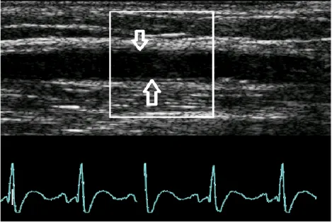 Figure  1.:    Ultrasound  measurement  of  the  diameter  of  brachial  artery. 