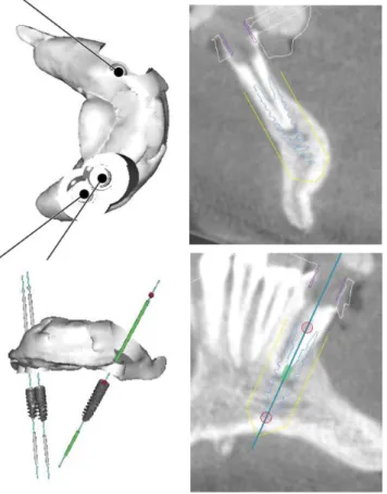 6. ábra Az implantációhoz használt CBCT műtéti sablon digitális képei  és a műtéti tervezési képek (A röntgenfelvétel keresztmetszeti  képén látható az extrém vékony állcsontgerinc)