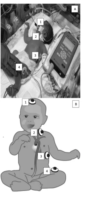4. ábra A) Az eszköz használat közben. B) Az elektródák felhelyezési  pontjait számokkal jelölve (a gyártó javaslatának megfelelően  újszülöttek esetén) a mellékelt séma mutatja