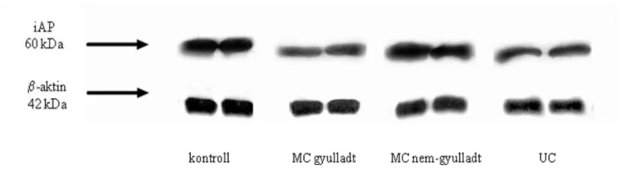 11. ábra: Az iAP fehérjeszintek reprezentatív eredményei a kontrollok, Crohn-beteg (MC) gyulladt  és  nem-gyulladt,  valamint  kolitisz  ulcerózás  (UC)  gyermekek  gyulladt  kolon  nyálkahártyájában  (Western blot)