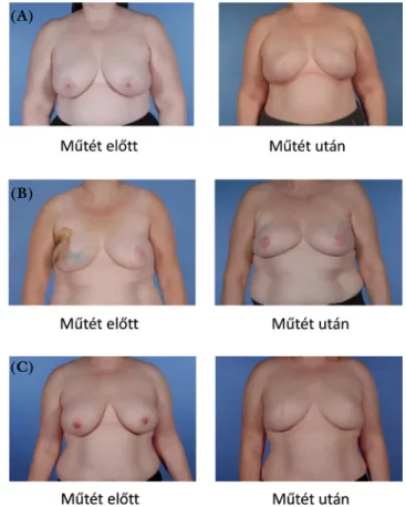 1. ábra Rizikócsökkentő kétoldali mastectomia és azonnali emlőre- emlőre-konstrukció implantátummal (New Victoria Hospital, Glasgow)  (A), kiterjesztett latissimus dorsi lebennyel (Queen Elizabeth  University Hospital, Glasgow) (B) és DIEP szabad lebennyel