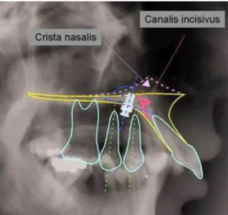 4. ábra A palatinális implantátum hagyományos pozicionálása (teleröntgenfelvétel) 