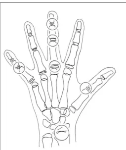6. ábra. A skelettalis maturáció indikátorainak lokalizációi: a hüvelykujj középső percén, a középső ujj  mindhárom percén, a kisujj középső percén és a radiuson (Fishman 1982) 