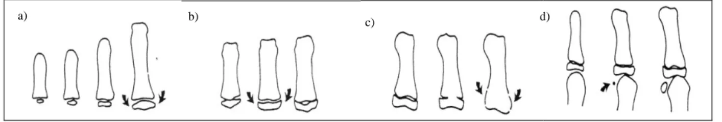 7. ábra: A skeletális maturáció négy indikátora: a) az ujjpercek epifízisének diafízishez viszonyított  szélessége b) az ún