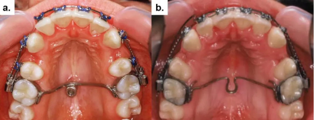 Fig. 1. Anchorage design in the palatal implant group (a) and in the dental anchorage group (b) during canine  retraction  