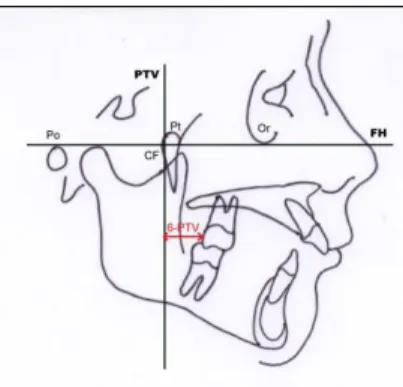 Fig. 2.  6-PTV distance on the lateral cephalogram 