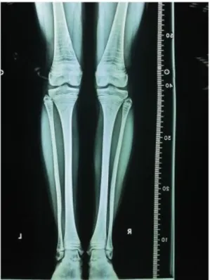 4. ábra: Többszörös zebra csíkok egy 14 éves, egyes típusú osteogenesis  imperfectában szenvedő nőbetegről készült felvételen