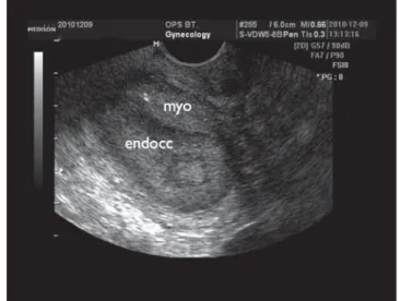 2. ábra Endometriumcarcinoma ultrahangképe. A szövettani feldol- feldol-gozás során igazolt, a bal oldali tubasarokból a méhűrbe törő  endometriumcarcinoma egy idős nőbetegben