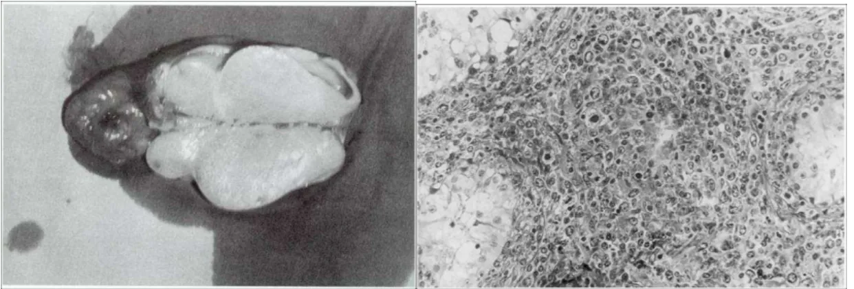 11. ábra Here lymphoma átmetszeti (A) és (B) szövettani képe 