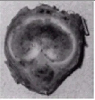 14. ábra Prosztatarák transurethralisresectiója után kialakult áttét a húgycs ő ben és a  barlangos testekben