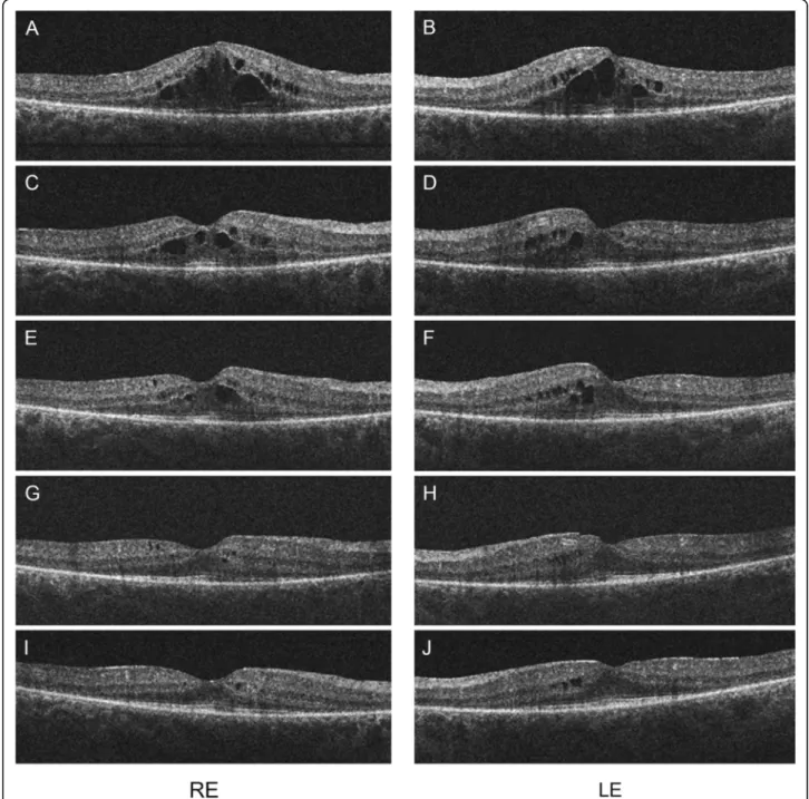 Figure 2 OCT scans of the macula of both eyes after 4 series of TAC treatment (A, B). Large cystic spaces are present in the outer nuclear layer and small cystic spaces in the inner nuclear layer