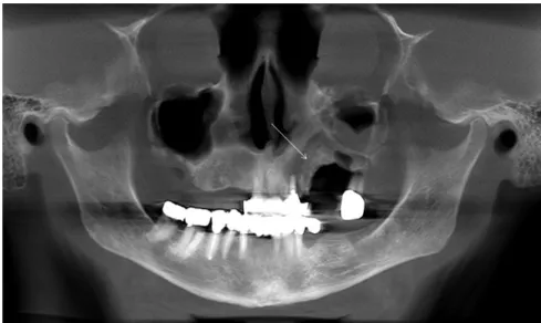12. ábra: OP felvételen fehér nyíl mutatja a szekvesztrálódott maxillaterületet  betegünknél 