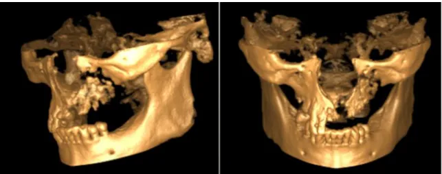 13. ábra: CBCT képen 3D-ben ábrázolt maxilla szekvesztráció betegünknél 