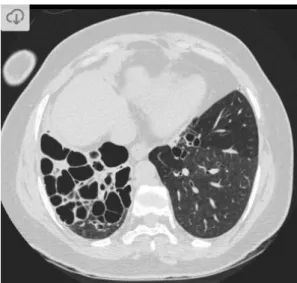 Figure 2 - High-resolution computed tomography image showing cystic bronchiectasis  in the right lung (45)