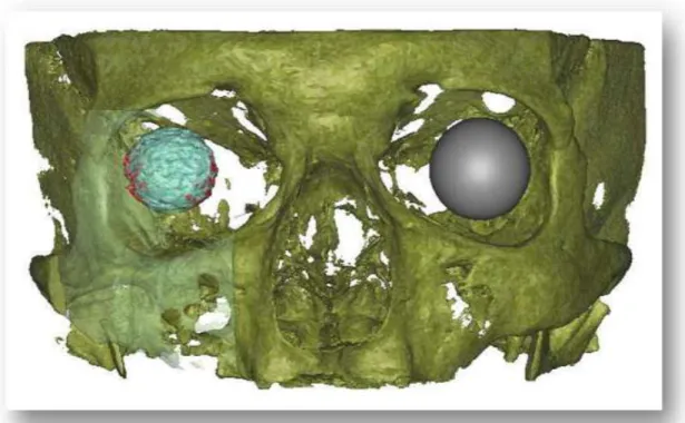9. ábra. Jobb oldalon a beültetett implantátum képe látható, világoskék a gyári értéken  belüli nagyság, pirossal jeleztük a gyári értéktől eltérő különbséget