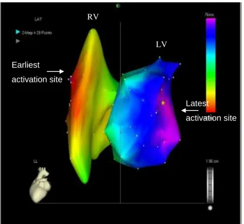 Figure  3.  Patient  1.  CARTO  image,  left  lateral  projection.  Right  and  the  left  ventricular  activation  map:  the  earliest  activation  site  is  the  right  ventricular  anteroseptal  region,  the  latest  one is the mid-basal part of the pos