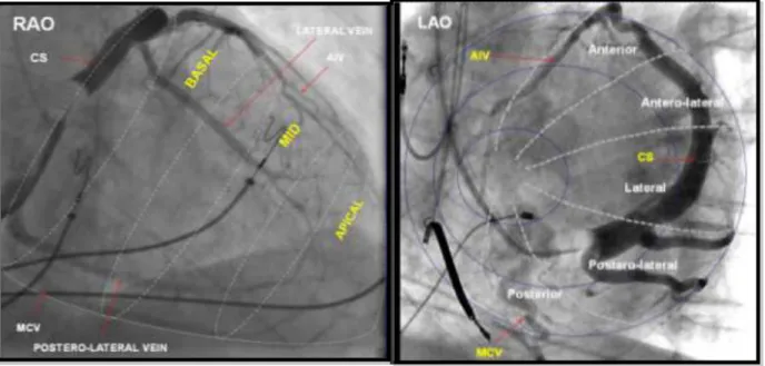 Figure  4.  Classification  of  LV  lead  location.  Sinus  venograms  in  RAO  (left  panel)  and  LAO  view  (right  panel)  representing  the  segments  of  the  left  ventricle  along  the  long-  and  the  short  axis  of  the  heart