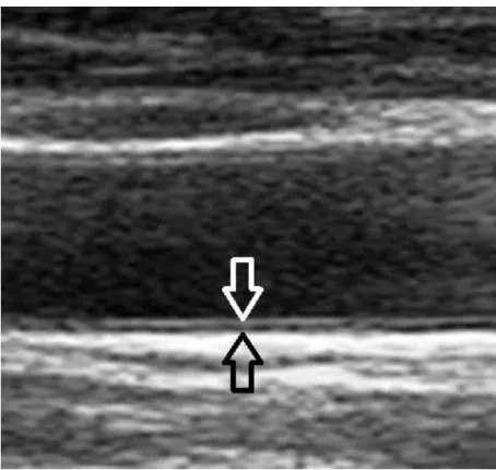 Figure 7. Intima-media thickness measurement by ultrasound   (white arrow: intima, black arrow: media layer)  