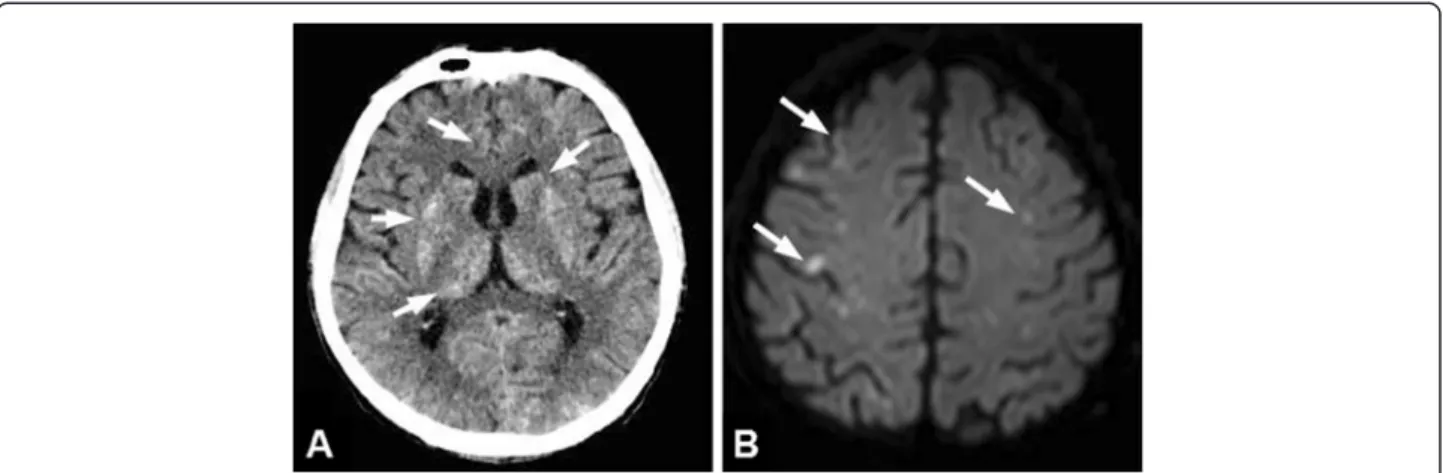 Figure 2 Cerebral iodized lipid emboli were detected shortly after the embolization procedure