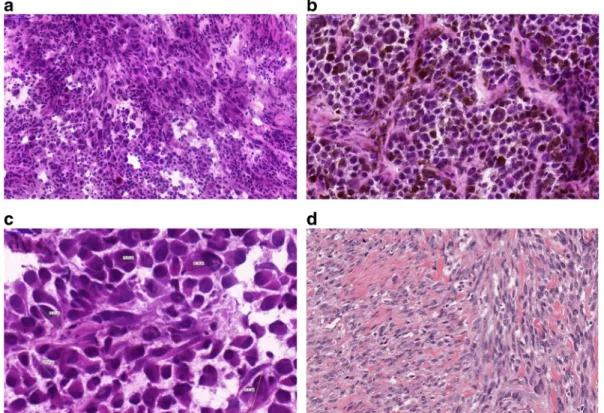 Fig. 1 Histological appearance of melanomas. a A non- non-pigmented tumor composed of malignant melanocytes infiltrated by lymphocytes b A pigmented tumor producing melanin mostly composed of epithelioid shaped cells (10 ×)