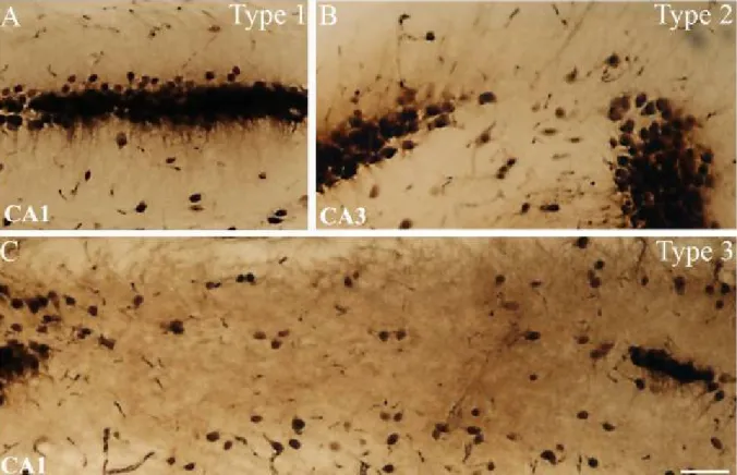 Figure 4: NeuN-staining shows different types of cell loss in the epileptic hippocampus  Based on the severity of principal cell loss, distinct regions were classified as type 1, 2 or 3