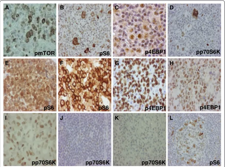 Figure 1 mTOR activity is increased in lymphoma cells. mTOR activity related phosphoproteins in different lymphomas detected by IHC.