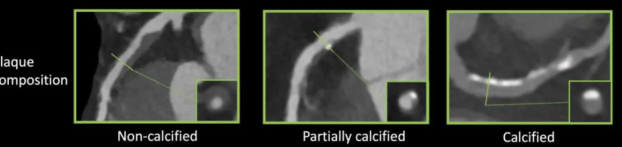 Figure  1.  Representative images  of  plaque  characteristics  identifiable  using  coronary  CTA (46)