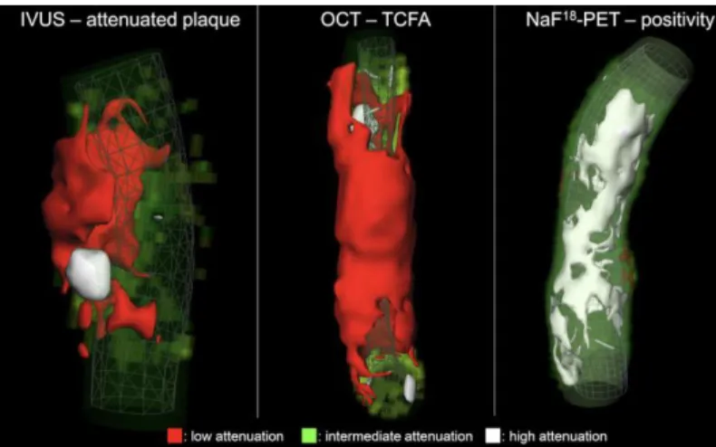 Figure  2.  Representative  volume  rendered  CT  images  of  three  coronary  plaques  corresponding  to  specific  invasive  and  radionuclide  imaging  markers of plaque vulnerability