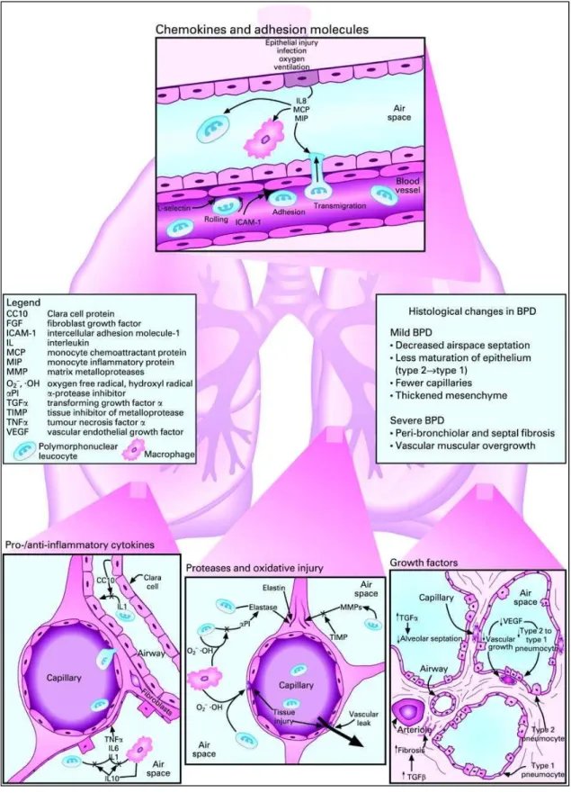 Figure  3.  Diagram  representing  critical  steps  and  associated  mediators  in  lung  inflammation, injury and remodelling that result in BPD [23]