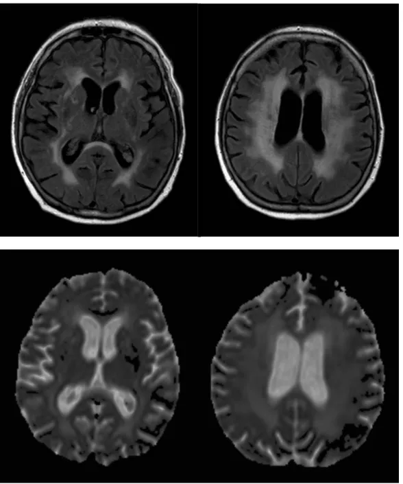 Figure 3. Diffuse white matter lesions in a 70 year-old hypertensive patient on axial FLAIR  image  (upper  row)  and  ADC  map  (lower  row)