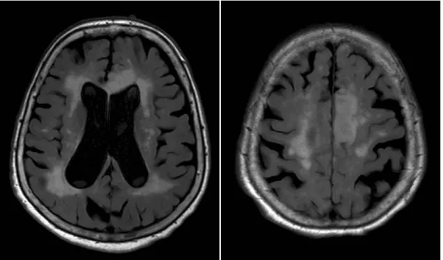 Figure 6. Widespread WMH and diffuse brain atrophy in a 89 year-old hypertensive patient  on axial FLAIR images