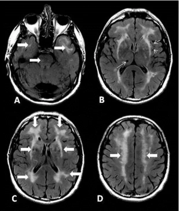 Figure  7.  Characteristic  MR  changes  on  axial  FLAIR  images  in  a  54  year  old  CADASIL  patient: A: WMH in the pons and temporal poles (large arrows)