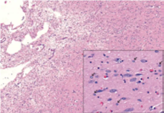 Fig. 6. Microscopic examination of the putamen  (H&amp;E, x4): the lesion had ill-defined borders,  inflammatory cells were not present