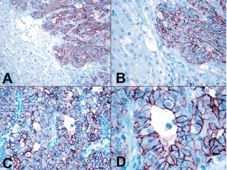 Fig. 2. A,B. Canine cholangiocarcinomas showed intense membrane positivity for claudin-7