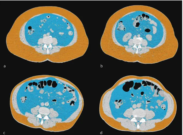 Figure 7. Abdominal subcutaneous and visceral adipose tissue compartments (SAT  and VAT) in monozygotic twin pairs - representative cases from the study 