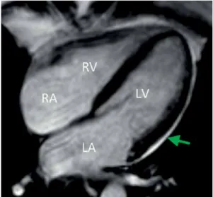 Figure 2. Epicardial adipose tissue (arrow) by using  magnetic resonance imaging (MRI) technique RA – right atrium, LA – left atrium, RV – right ventricle,  LV – left ventricle.