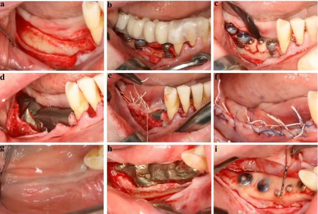 Fig.  2  Surgical  treatment  approach  for  horizontovertical  ridge  reconstruction  (Case  Three)