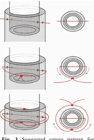 Fig.  3  Suggested  suture  pattern  for  cannulation.  Note:  Adapted  from  “Corrosion  Casting,  a  Known  Technique  for  the  Study  and  Teaching  of  Vascular  and  Duct  Structure  in  Anatomy”  by  Rueda  Esteban  RJ,  López  McCormick  JS,  Martí