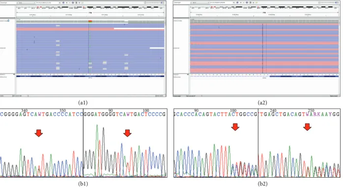 Figure 1: The identified mutations of patient 5. Both c.3809A&gt;T (causing amino acid change p.Ala1270Ile) and c.1707+2dupT mutations are confirmed by Sanger-sequencing